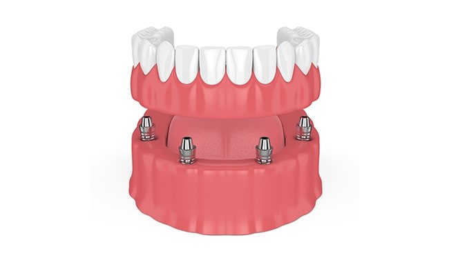 Lower Dentures Won'T Stay In Waterbury NE 68785